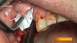 Posterior Maxilla implantation after wisdom tooth extraction with GBR 관련사진