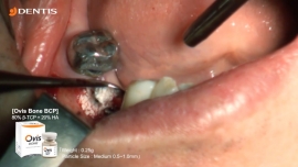 Posterior Mandibula Implant Installation with GBR 관련사진