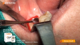 Posterior Mandibula Implant Installation Single Case with GBR 관련사진