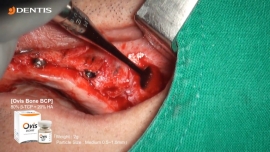 Sinus Lift Bone Grafting with Immediate Implant Installation 관련사진