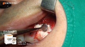 One Grafting after Removal Implant Fixture 관련사진