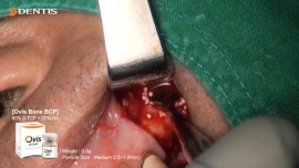Sinus Lift Bone Grafting after Removal Implant Fixture 관련사진