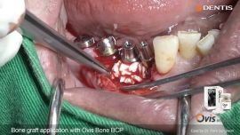 #45, #46 Implant installation with bone graft 관련사진